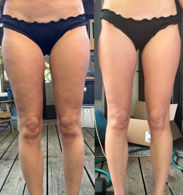 CelluSculpt™ Vacuümmassage