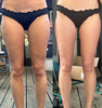 CelluSculpt™ Vacuümmassage