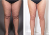 PerfectWave™ Body Sculptor